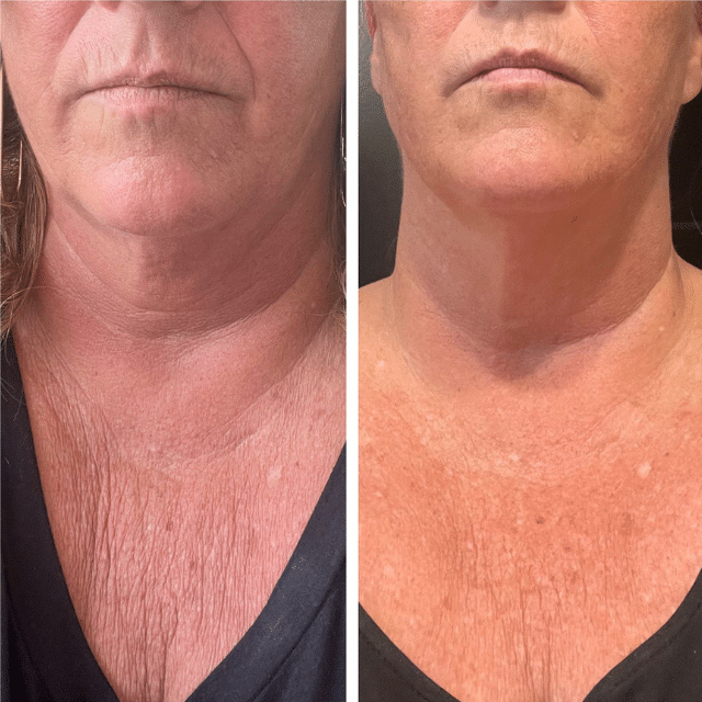 Age with grace and reverse aging with activated liquid collagen